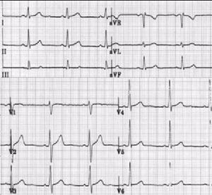 仲景传人文集      一个心动周期,在心电图上可有5个或6个波,从左至右